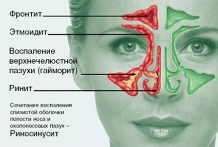 Rinosinuzita - cauze, semne, simptome și tratament