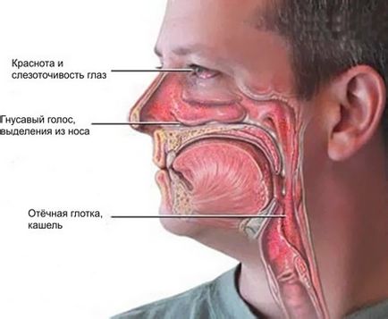 Rinosinuzita - cauze, semne, simptome și tratament