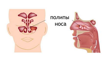 Simptomele rinosinuzita și tratamentul acute, cronice, polypoid
