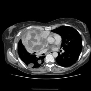 Sarcom - ce fel de simptome, tabloul bolii, cauze, tipuri, tratament și prognostic