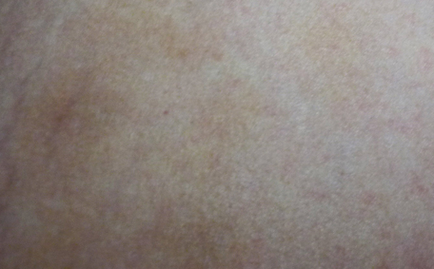 descuamarea pielii între fotografie picioare, este posibil boala, tratament, excrescente pe piele