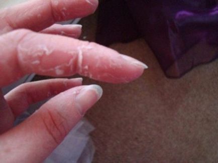 descuamarea pielii pe degetele de la cauzele și tratamentul mâinilor