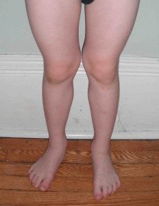 Conurile de pe picior de mai jos cauzele și tratamentul