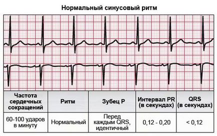 ritm sinusal a inimii ceea ce înseamnă, de înregistrare modificări ECG