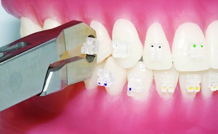 acolade Demontarea - proces efectuat exclusiv ortodont