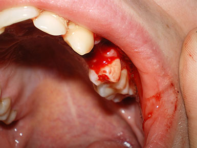 acolade Demontarea - proces efectuat exclusiv ortodont