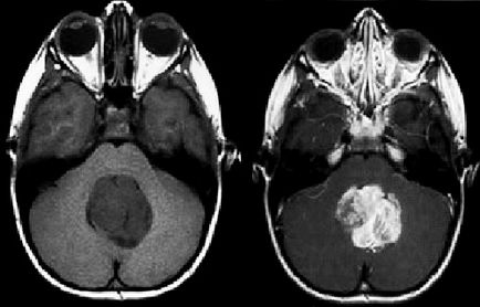 Tratamentele actuale de cancer (metode de diagnostic de cancer) Metode moderne pentru tratamentul cancerului