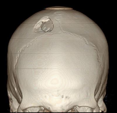 Parietal os 2