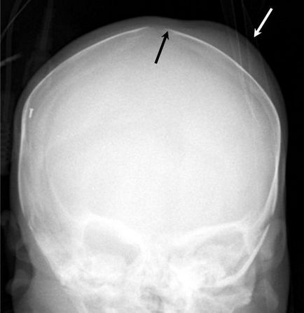 Parietal os 2