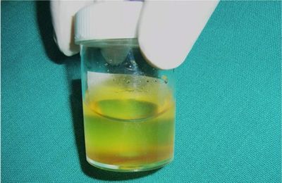 Cauzele urină închisă la culoare și tratament