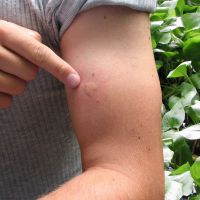 mușcături de țânțar - cum pentru a elimina umflarea