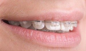 Tipuri de acolade și acolade de metal pe sistemele dumneavoastră de dinți, care sunt