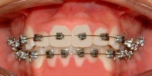 Tipuri de acolade și acolade de metal pe sistemele dumneavoastră de dinți, care sunt
