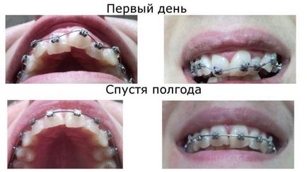 Tipuri de suporturi pe dinti aparat dentar foto și dinții înainte și după tratament