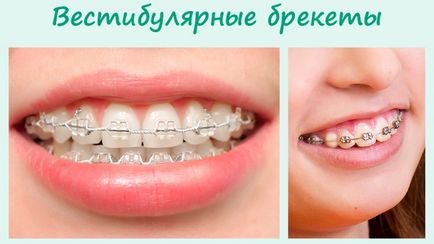 Tipuri de suporturi pe dinti aparat dentar foto și dinții înainte și după tratament