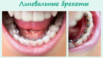 Tipuri de suporturi pe dinti aparat dentar foto și dinții înainte și după tratament