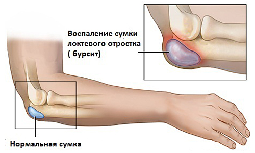 як лікувати бурсит ліктя будинку