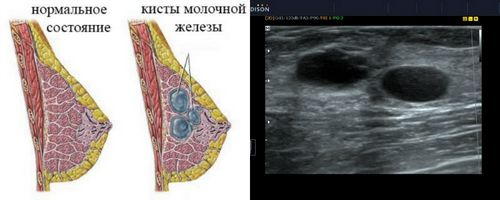 кіста в молочній залозі