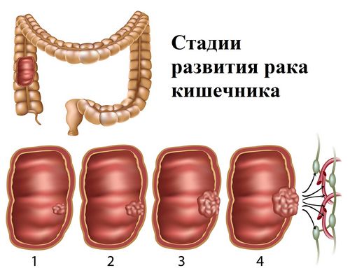 як лікувати рак кишечника