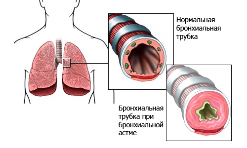 як лікувати астму алое