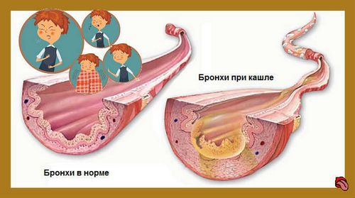 інфекція