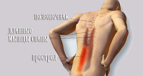 як лікувати м'язи спини