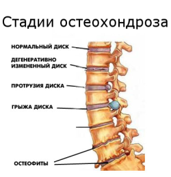 як лікувати остеохондроз самостійно