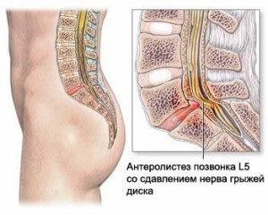 як лікувати остеохондроз другого ступеня