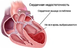 як лікувати артроз великого пальця руки