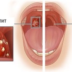 як вилікувати тонзиліт назавжди
