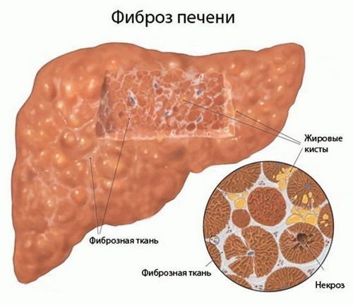 як лікувати фіброз печінки 2 стадії