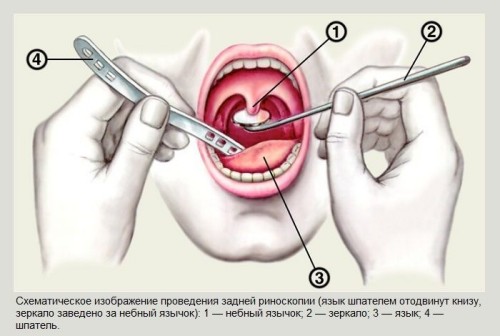 як лікувати задній риніт у дитини