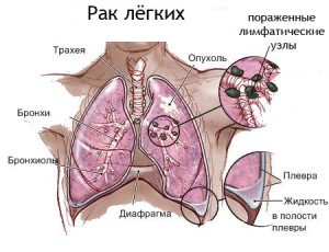 як лікувати пневмонію на ранніх стадіях