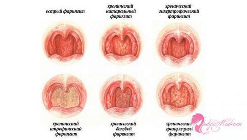 хронічний фарингіт нежить