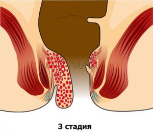 геморой стадія перша 1 друга 2 третя 3 четверта 4 причини лікування
