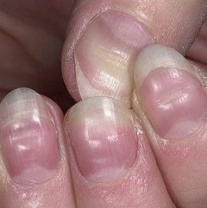 як лікувати нерівні нігті