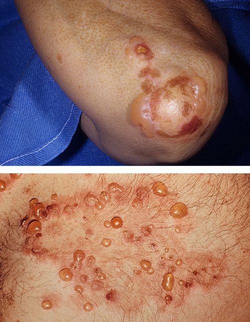 герпетиформний дерматит Дюринга фото у дітей лікування симптоми бульозний