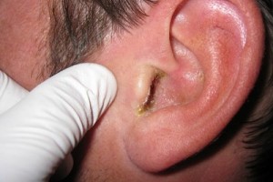 як вилікувати грибок вух