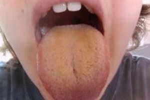 язик обкладений жовтим нальотом причини