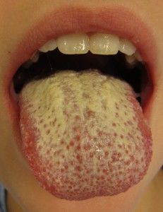 як лікувати шорсткий язик