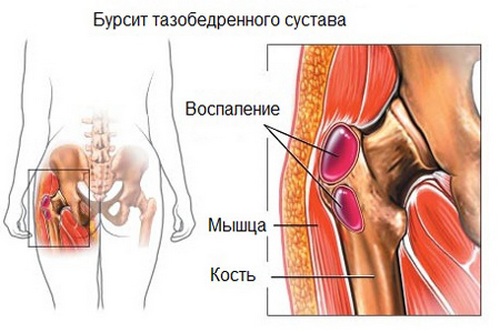 як лікувати бурсит стегна