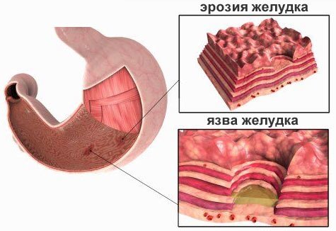 як лікувати ерозію шлунка