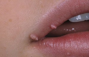 як лікувати папіломи на губах