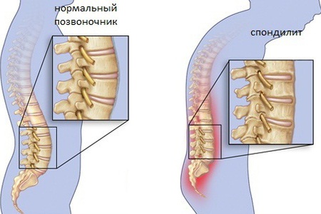 як лікувати туберкульоз кісток народними засобами