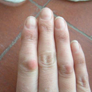 запалення суглобів пальців рук