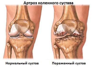 ніж лікувати артроз колінного суглоба