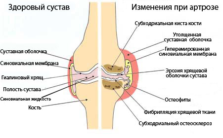 ніж лікувати артроз колінного суглоба