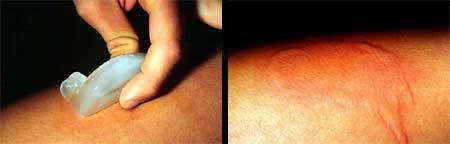 алергія на холод холодова симптоми лікування руках як лікувати проявляється особі крем від холодової алергії причини ногах дерматит буває шкірі