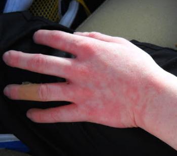 алергія на холод холодова симптоми лікування руках як лікувати проявляється особі крем від холодової алергії причини ногах дерматит буває шкірі