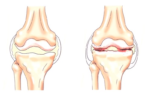 як лікувати артроз 2 ступеня колінного суглоба